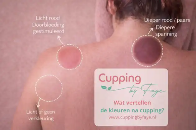 Wat vertellen de kleuren op je huid na een behandeling? - Cupping by Faye - Groningen