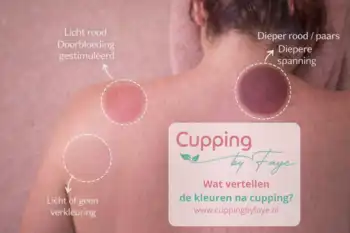 Wat vertellen de kleuren op je huid na een behandeling? - Cupping by Faye - Groningen